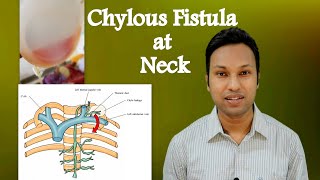 Chylous Fistula at Neck Peroperative amp Postoperative Identification Technique amp Management [upl. by Olyhs]