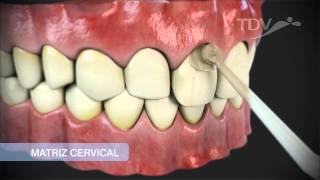 MATRIZ CERVICAL TDV  Restauraciones de Clase V [upl. by Steffane183]