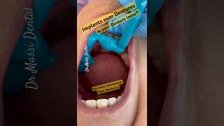 Implants  Dentures no more movement my Dentures [upl. by Anselm]