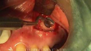 Trephine Technique for Lateral Sinus Window [upl. by Rohpotsirhc]