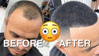 BEFORE amp AFTER From being BALD to FULL HEAD OF HAIR [upl. by Telimay]