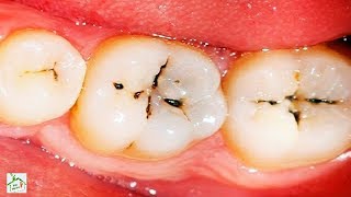 DONT GO TO THE DENTIST Cure Dental Caries with these tricks in just 6 steps INTERESTING [upl. by Eislehc]