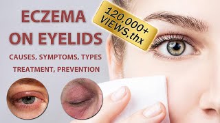 Eczema on Eyelids 2022  2023  Causes Symptoms Types Treatment and Prevention [upl. by Dillie728]