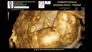 Hygroma Kistik  Hydrops Fetalis 12 Weeks  Trisomi [upl. by Anaujahs487]