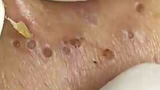 Blackheads amp Whiteheads Satisfying Removal 0066 [upl. by Maiga]