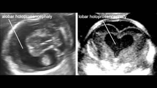 Holoprosencephaly [upl. by Thorpe]