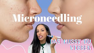 Microneedling  ALLES WAS DU WISSEN MUSST [upl. by Calica]