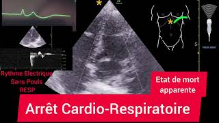 Arrêt CardioRespiratoire Échographie [upl. by Griselda]