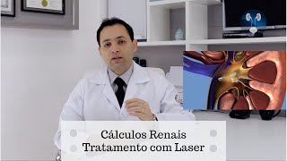 Pedras nos rins  Tratamento com Laser [upl. by Nara912]