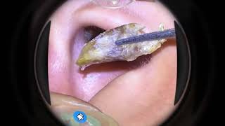 Blocked Ear Cleaning 12 [upl. by Aehc]