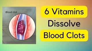 6 Vitamins To Dissolve Your Blood Clots [upl. by Addiel]