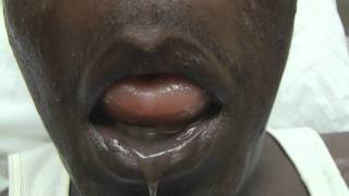 ACE Inhibitor Tongue Angioedema Emergency [upl. by Acnaiv449]