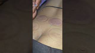 sciatica pain acupuncture treatment [upl. by Kora336]