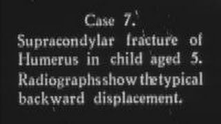 Recent advances in fracture treatment Part 5 c1932 [upl. by Enylekcaj]