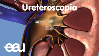 Tratamiento de cálculos renales y ureterales URS [upl. by Jb610]