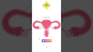 Fallopian tube blockage Treatment without operation fallopiantubeblockage uttarbastti infertility [upl. by Gemini250]