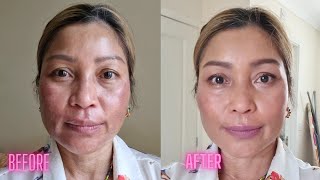 Full coverage makeup for melasma melasma [upl. by Grindlay]