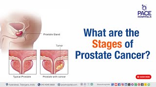 Stages of Prostate Cancer  What are the stages of prostate cancer  prostatecancer [upl. by Heyman]