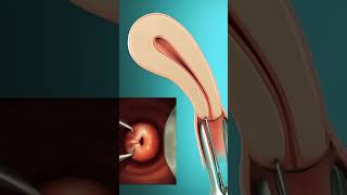 IUD insertion How to prevent pregn🤰 [upl. by Anattar999]