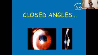 Lecture Glaucoma following Congenital Cataract Surgery Dr Sirisha Senthil [upl. by Aitnyc760]