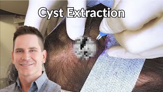 Pearl Shaped Cyst Excavated from Scalp  CONTOUR DERMATOLOGY [upl. by Nichole682]