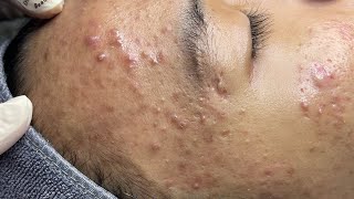 ACNE TREATMENT VU QUYNH MI  Perennial Blackheads On Boy Face 2024FULL [upl. by Liakim]