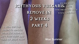 Best ichthyosis vulgaris treatment dry skin removed in 2 weeks part 4 [upl. by Corbin388]