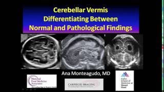 AIUM Webinar Cerebellar Vermis [upl. by Yadahs]