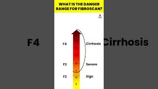 What is the danger range for FibroScan  Fibroscan  Liver Fibrosis Treatment viral hepatitis [upl. by Aicnelav333]