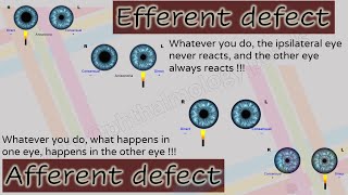 Pupil 2  Characteristics of Afferent and Efferent Pupillary Defects [upl. by Etolas]