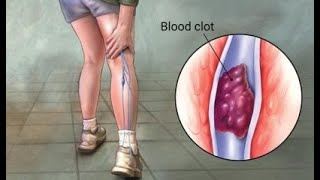 DVT with IVC Filter CDT [upl. by Sandra256]