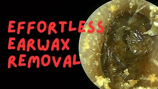 Effortless Earwax Removal [upl. by Aekahs299]