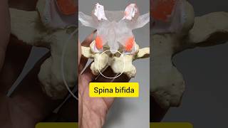 Spinal Bifida Dynamic Disc Model lumbar [upl. by Alwin]