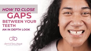 How To Close Gaps Between Your Teeth An In Depth Look  Dental Boutique [upl. by Ashil]