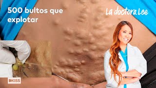 500 bultos por todo el cuerpo La doctora Lee [upl. by Ailemac320]