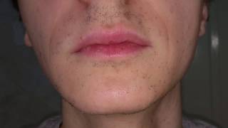 Lumenis Lightsheer Duet  male facial hair removal  1 year after [upl. by Annaoy]