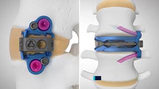 ELSA™ Expandable Integrated Lateral Lumbar Interbody Technique Animation [upl. by Ayotl]