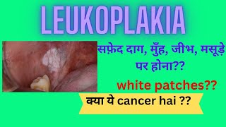 leukoplakiawhite patch causes and treatment [upl. by Aicnatsnoc]