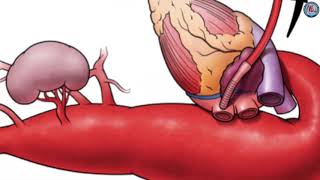 Thoracoabdominal aortic aneurysm repair in Marfan Syndrome How we do it [upl. by Lash24]