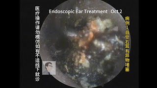 Treatment of cerumen embolism 20231002 [upl. by Ellmyer]