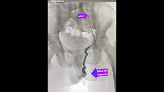 Varicocele Embolisation Angiography venogram of left gonadal vein in a man suffering from [upl. by Venditti]