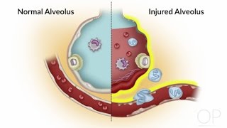 Fluid Management in Acute Respiratory Distress Syndrome by S Valentine M Grunat  OPENPediatrics [upl. by Zetnod]