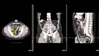 ¿Qué es la Abdominoplastía [upl. by Akinert]