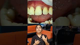 Teeth gap filling பன்னா செயற்கையாக தெரியுமாshorts [upl. by Atwater]