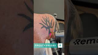 How does laser tattooremoval actually work Check the comments amp learn more removery [upl. by Gensler]