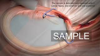 Shoulder arthroscopy stock 3D animation [upl. by Llerrehc]