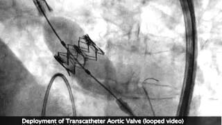 SAPIEN TAVR Deployment Under Flouroscopy Ultrasound [upl. by Mila]