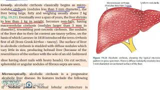 Pathology 605 e Alcoholic Liver Disease Morphology MicroNodular Hobnail Mallory body [upl. by Chaker867]