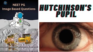 NEET PG Hutchinson pupil amp Kernohan notch imagebasedquestion neetpg neetpgpreparation sureshot [upl. by Seton]