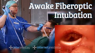 Awake Fiberoptic Intubation [upl. by Thgiwed]